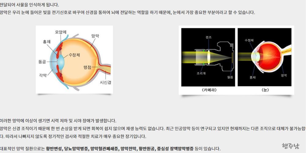 망막질환 황반변성 당뇨망막병증 텍스트 이미지