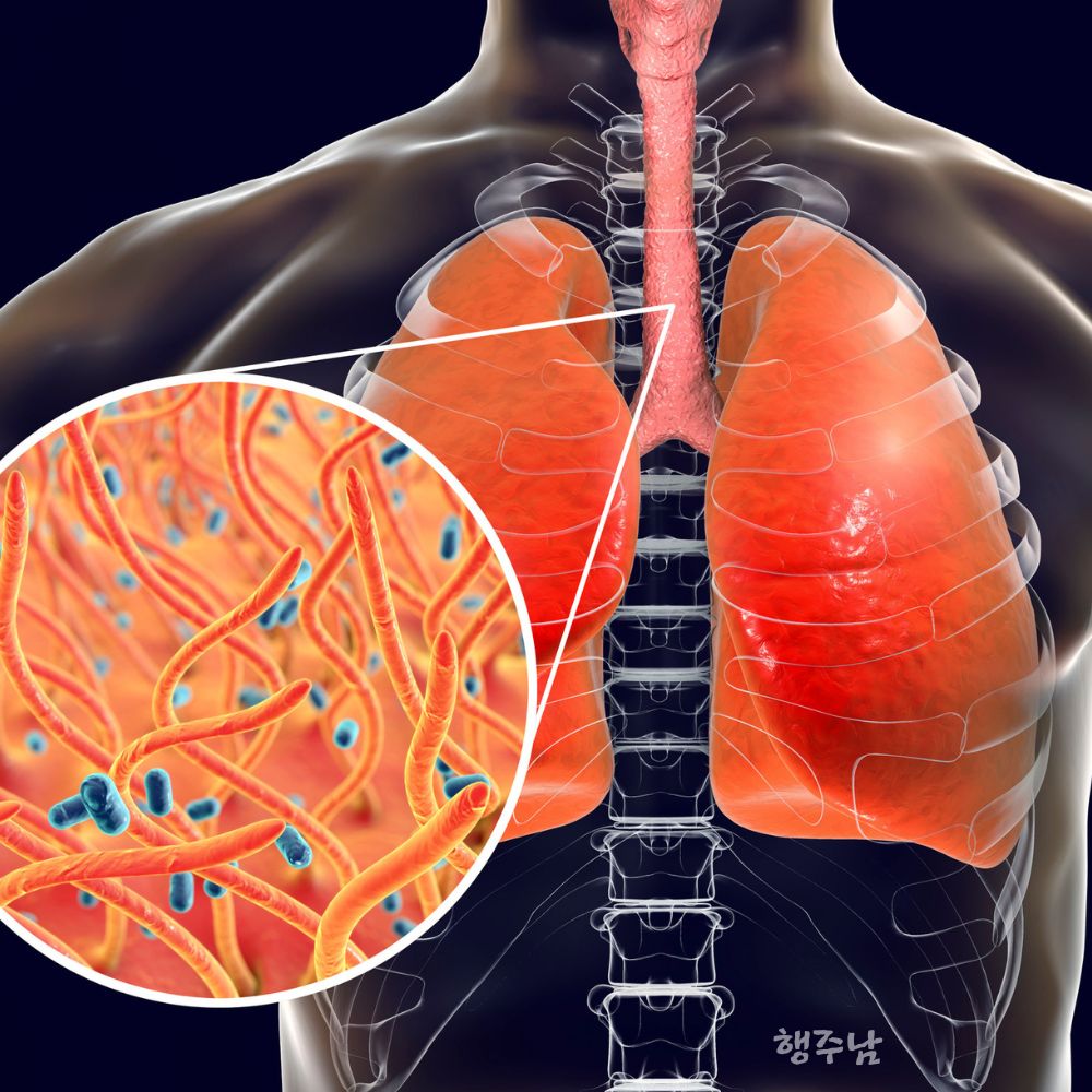 가래 기침 계속된다면 폐암 초기증상 폐 이미지